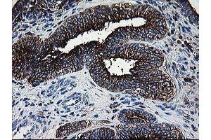 Immunohistochemical staining of paraffin-embedded Adenocarcinoma of Human endometrium tissue using anti-DTYMK mouse monoclonal antibody. (DTYMK 抗体)