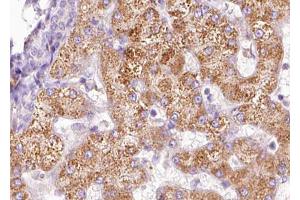 ABIN6267633 at 1/100 staining human liver carcinoma tissue sections by IHC-P. (PAK1 抗体  (pThr212))