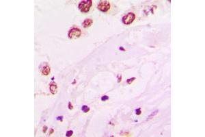 Immunohistochemical analysis of HKR1 staining in human lung cancer formalin fixed paraffin embedded tissue section.