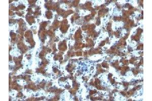IHC testing of FFPE human hepatocellular carcinoma and RBP antibody (clone G4E4). (RBP1 抗体  (AA 74-182))
