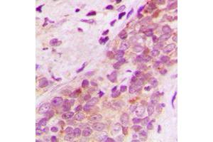 Immunohistochemical analysis of AIP-1 staining in human breast cancer formalin fixed paraffin embedded tissue section. (WDR1 抗体  (Center))