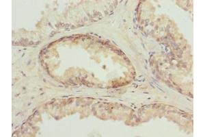 Immunohistochemistry of paraffin-embedded human prostate cancer using ABIN7173695 at dilution of 1:100 (TUBb6 抗体  (AA 1-446))