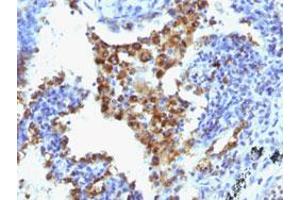 Immunohistochemical staining (Formalin-fixed paraffin-embedded sections) of human lung adenocarcinoma with NAPSA monoclonal antibody, clone NAPSA/1238 + NAPSA/1239 .