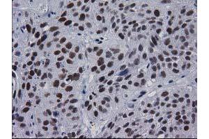 Immunohistochemical staining of paraffin-embedded Carcinoma of Human bladder tissue using anti-MYD88 mouse monoclonal antibody. (MYD88 抗体)