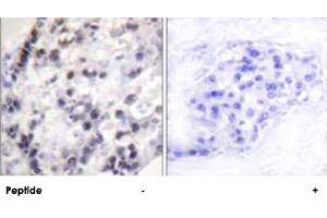 Immunohistochemistry analysis of paraffin-embedded human breast carcinoma tissue using HNRNPC polyclonal antibody . (HNRNPC 抗体  (Ser260))