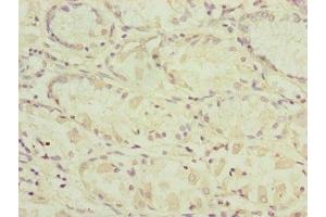 Immunohistochemistry of paraffin-embedded human gastric cancer using ABIN7164324 at dilution of 1:100 (RARS2 抗体  (AA 17-340))