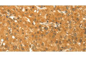 Immunohistochemistry of paraffin-embedded Human liver cancer using TM7SF2 Polyclonal Antibody at dilution of 1:30 (TM7SF2 抗体)