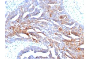 Formalin-fixed, paraffin-embedded human Ovarian Carcinoma stained with TAG-72 Mouse Monoclonal Antibody (B72. (TAG-72 / CA72.4 抗体)