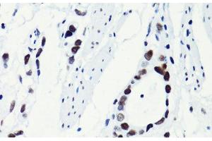 Immunohistochemistry of paraffin-embedded Human gastric cancer using Acetyl-Histone H2B-K5 Polyclonal Antibody at dilution of 1:100 (40x lens). (Histone H2B 抗体  (acLys5))