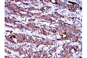 Immunohistochemical analysis of paraffin-embedded human cervical cancer tissues using KRT19 mouse mAb with DAB staining. (Cytokeratin 19 抗体)