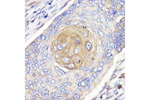 Immunohistochemistry of paraffin-embedded human esophageal cancer using FGFR3 Rabbit mAb (ABIN7267191) at dilution of 1:100 (40x lens). (FGFR3 抗体)
