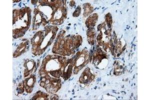 Immunohistochemical staining of paraffin-embedded Adenocarcinoma of ovary tissue using anti-RALBP1 mouse monoclonal antibody. (RALBP1 抗体)