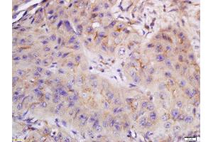 Formalin-fixed and paraffin embedded human laryngocarcinoma labeled with Anti-CYB5R4 Polyclonal Antibody, Unconjugated  at 1:200 followed by conjugation to the secondary antibody and DAB staining. (CYB5R4 抗体  (AA 21-120))
