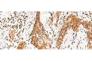 Immunohistochemistry of paraffin-embedded Human esophagus cancer tissue using DGCR6L Polyclonal Antibody at dilution of 1:65(x200) (DGCR6L 抗体)
