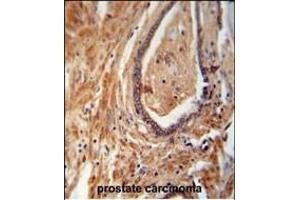 NDUFAF1 antibody (C-term) (ABIN654702 and ABIN2844394) immunohistochemistry analysis in formalin fixed and paraffin embedded human prostate carcinoma followed by peroxidase conjugation of the secondary antibody and DAB staining.