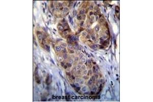 GEA12 antibody (N-term) (ABIN390104 and ABIN2840616) immunohistochemistry analysis in forlin fixed and paraffin embedded hun breast carcino followed by peroxidase conjugation of the secondary antibody and DAB staining. (MAGEA12 抗体  (N-Term))