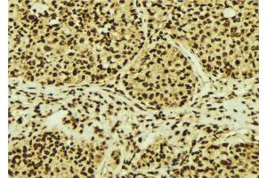 ABIN6274755 at 1/100 staining Human breast cancer tissue by IHC-P. (RPS3 抗体  (Internal Region))