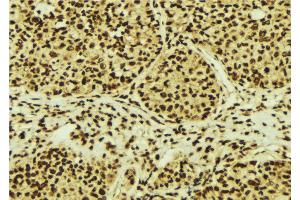 ABIN6274755 at 1/100 staining Human breast cancer tissue by IHC-P.