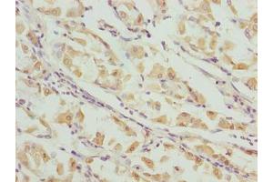 Immunohistochemistry of paraffin-embedded human gastric cancer using ABIN7156409 at dilution of 1:100 (Integrator Complex Subunit 14 (INTS14) (AA 231-518) 抗体)