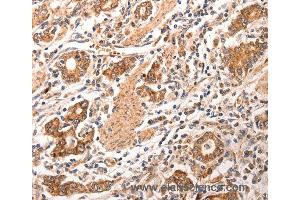 Immunohistochemistry of Human gastric cancer using CCL17 Polyclonal Antibody at dilution of 1:70 (CCL17 抗体)