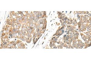 Immunohistochemistry of paraffin-embedded Human thyroid cancer tissue using COA7 Polyclonal Antibody at dilution of 1:55(x200) (C1orf163 抗体)