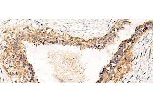 Immunohistochemistry of paraffin-embedded Human breast cancer tissue using GPR152 Polyclonal Antibody at dilution of 1:55(x200) (GPR152 抗体)