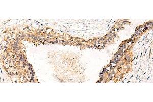 Immunohistochemistry of paraffin-embedded Human breast cancer tissue using GPR152 Polyclonal Antibody at dilution of 1:55(x200) (GPR152 抗体)