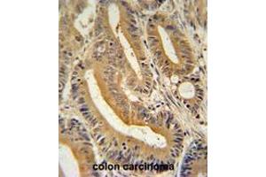 AP3S1 antibody (N-term) immunohistochemistry analysis in formalin fixed and paraffin embedded human colon carcinoma followed by peroxidase conjugation of the secondary antibody and DAB staining. (AP3S1 抗体  (N-Term))
