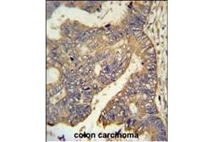 R6G Antibody (N-term) (ABIN650946 and ABIN2840004) IHC analysis in formalin fixed and raffin embedded human colon carcinoma followed by peroxidase conjugation of the secondary antibody and DAB staining. (PARD6G 抗体  (N-Term))