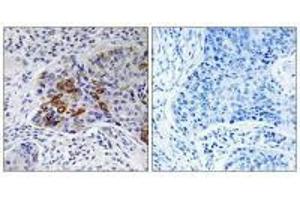 Immunohistochemistry analysis of paraffin-embedded human lung carcinoma tissue, using ADCY9 antibody. (ADCY9 抗体  (N-Term))
