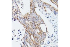 Immunohistochemistry of paraffin-embedded human colon carcinoma using L1 Rabbit pAb (ABIN6134555, ABIN6137248, ABIN6137250 and ABIN6215529) at dilution of 1:100 (40x lens). (ATG16L1 抗体  (AA 200-300))