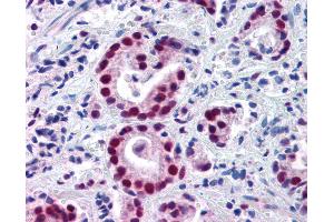 Anti-HDAC1 antibody IHC of human prostate carcinoma. (HDAC1 抗体  (AA 466-482))