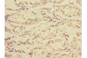 Immunohistochemistry of paraffin-embedded human gastric cancer using ABIN7172004 at dilution of 1:100 (TXNDC5 抗体  (AA 1-324))