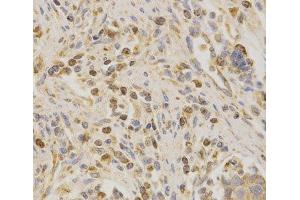 Immunohistochemistry of paraffin-embedded Human stomach cancer using BAK1 Polyclonal Antibody at dilution of 1:200 (40x lens). (BAK1 抗体)