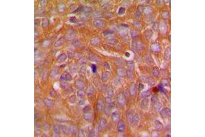 Immunohistochemical analysis of CARD14 staining in human breast cancer formalin fixed paraffin embedded tissue section. (CARD14 抗体  (Center))