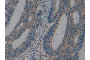 IHC-P analysis of Human Colorectal cancer Tissue, with DAB staining. (LAP 抗体  (AA 320-519))
