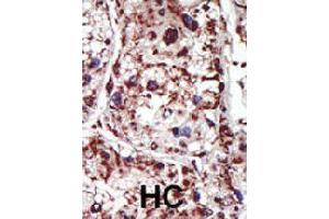 Formalin-fixed and paraffin-embedded human hepatocellular carcinoma tissue reacted with PACSIN1 polyclonal antibody  , which was peroxidase-conjugated to the secondary antibody, followed by DAB staining.