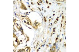 Immunohistochemistry of paraffin-embedded human liver cancer using TMOD4 antibody at dilution of 1:100 (x40 lens).