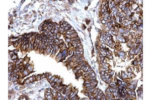 IHC-P Image IFITM1 antibody detects IFITM1 protein at cytosol and membrane on human ovarian carcinoma by immunohistochemical analysis. (IFITM1 抗体)