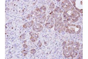 IHC-P Image Immunohistochemical analysis of paraffin-embedded NCIN87 xenograft, using Amphiphysin, antibody at 1:100 dilution. (Amphiphysin 抗体  (N-Term))