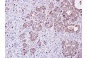 IHC-P Image Immunohistochemical analysis of paraffin-embedded NCIN87 xenograft, using Amphiphysin, antibody at 1:100 dilution. (Amphiphysin 抗体  (N-Term))