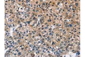 The image on the left is immunohistochemistry of paraffin-embedded Human liver cancer tissue using ABIN7128679(BPI Antibody) at dilution 1/50, on the right is treated with fusion protein. (BPI 抗体)