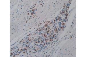 IHC-P analysis of Human Stomach Cancer Tissue, with DAB staining. (PTPRQ 抗体  (AA 36-294))