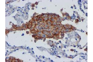 Immunohistochemical staining of paraffin-embedded Carcinoma of Human lung tissue using anti-CD80 mouse monoclonal antibody. (CD80 抗体)