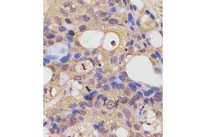(ABIN6243855 and ABIN6577442) staining RK7 in human breast carcinoma sections by Immunohistochemistry (IHC-P - raformaldehyde-fixed, raffin-embedded sections). (PARK7/DJ1 抗体  (C-Term))