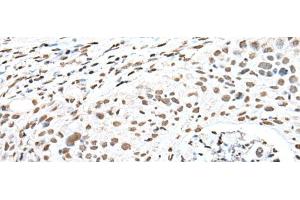 Immunohistochemistry of paraffin-embedded Human lung cancer tissue using SNRPA Polyclonal Antibody at dilution of 1:30(x200) (SNRPA1 抗体)