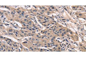 Immunohistochemistry of paraffin-embedded Human lung cancer using PEBP1 Polyclonal Antibody at dilution of 1:40 (PEBP1 抗体)