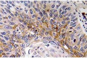 Immunohistochemistry (IHC) analyzes of Cardiotrophin-1 antibody in paraffin-embedded human lung carcinoma tissue. (Cardiotrophin 1 抗体)