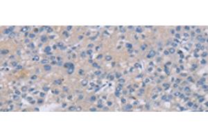 Immunohistochemistry of paraffin-embedded Human liver cancer tissue using CREBZF Polyclonal Antibody at dilution of 1:50(x200) (CREBZF 抗体)