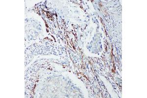 Anti-SHC antibody, IHC(P) IHC(P): Human Lung Cancer Tissue